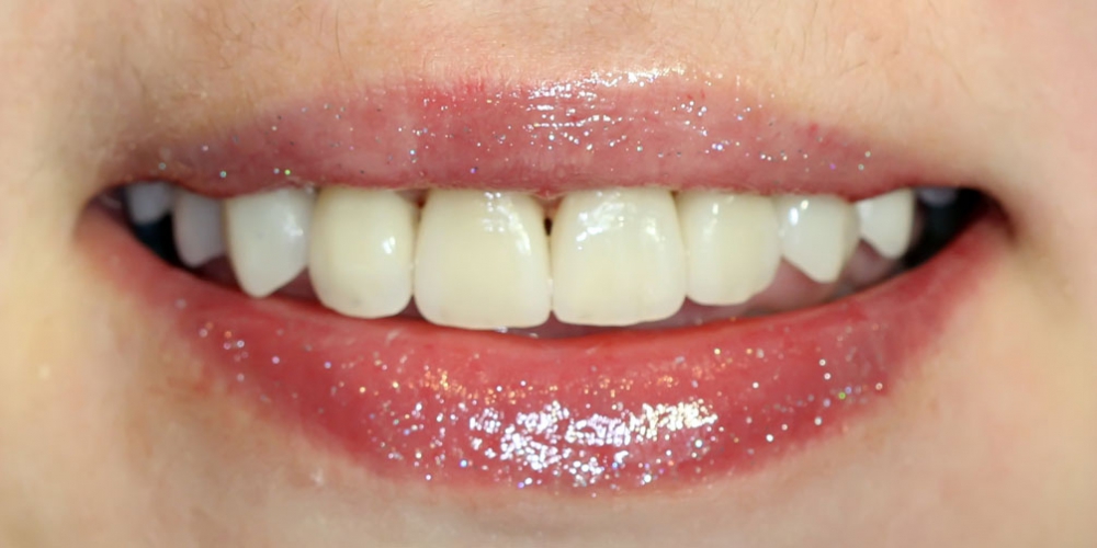  Установка виниров при патологической стираемости зубов