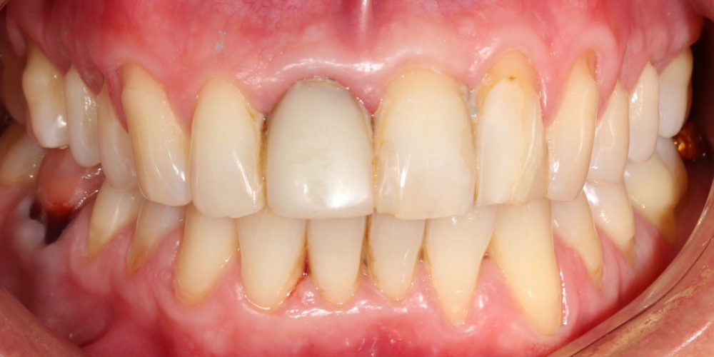  Керамические виниры на передние зубы