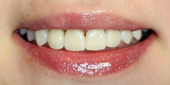 Установка виниров при патологической стираемости зубов фото после лечения